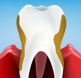 Periodontitis: Symptoms, Causes, and Treatments