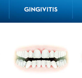 What is Gingivitis? Symptoms, Causes, and Treatments