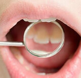 Gumline Cavities: How are they different?