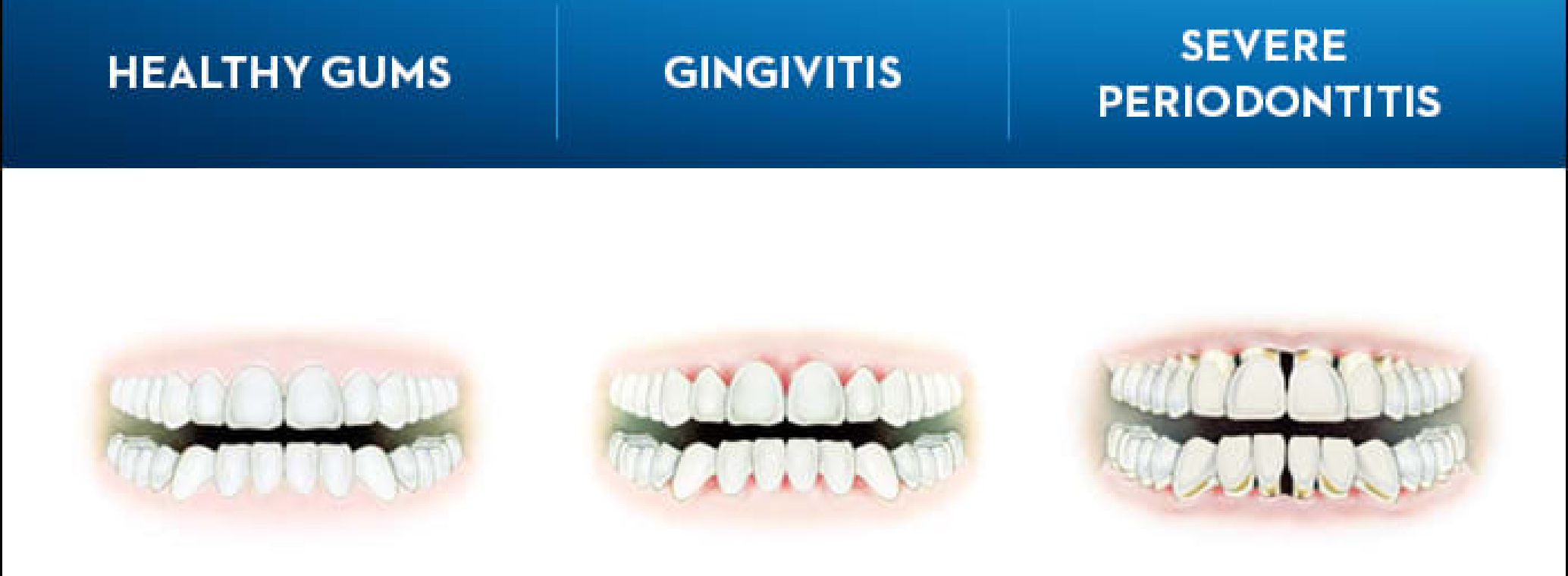 What is Gingivitis? Symptoms, Causes, and Treatments
