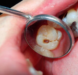 Can cavities go away on their own?