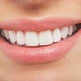 How Much Does Whitening Cost?